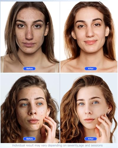 Clarea Intensive Anti-Aging Care LED – Red Light  Reduces wrinkles & Blue Light for Acne, 150 LEDS⭐️⭐️